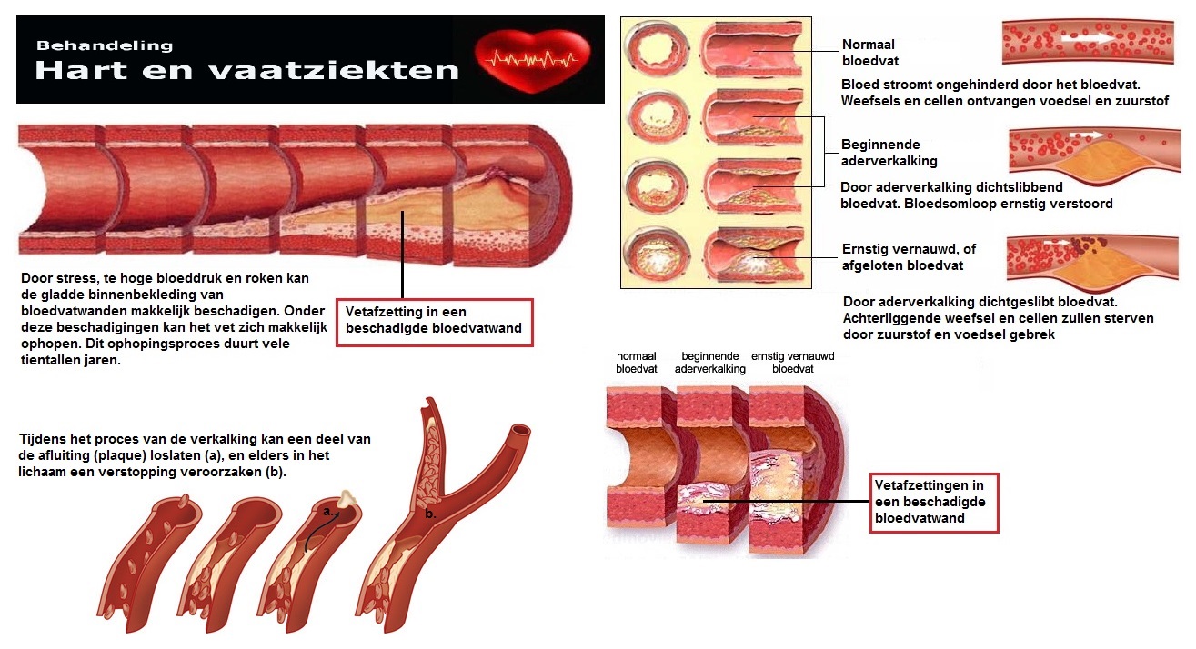 Aderverkalking in de slagaderen.